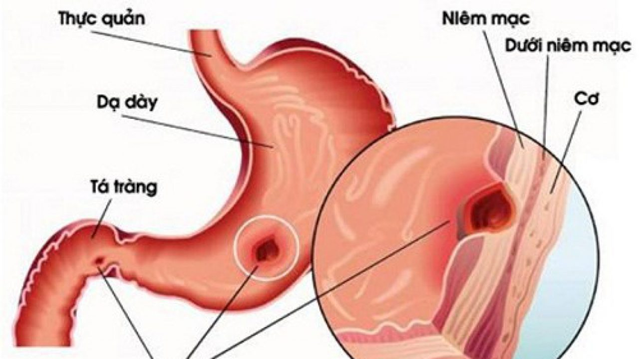 Khi say rượu nôn ra mật vàng, người uống rượu sẽ có nguy cơ gặp tình trạng viêm niêm mạc dạ dày