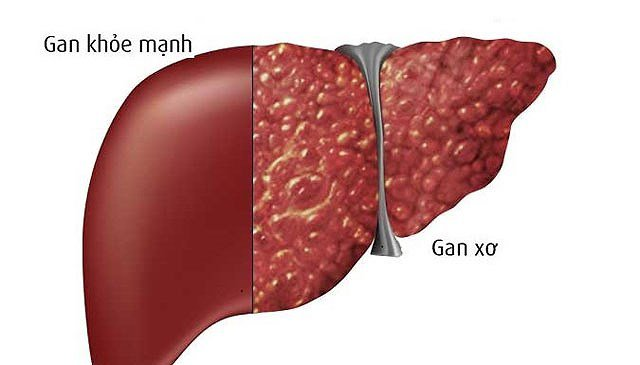 Lạm dụng rượu bia tăng nguy cơ xơ gan