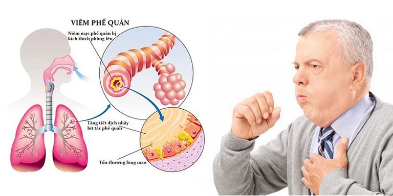 Bệnh viêm phế quản mãn tính có lây không?