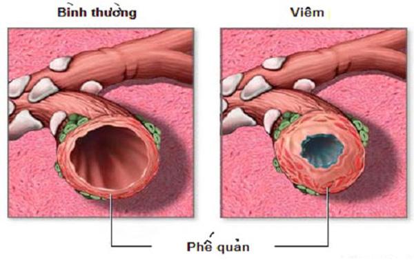 Phế quản của người khỏe mạnh và của người bệnh viêm phế quản mạn tính