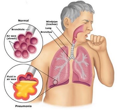 Ho có đờm màu vàng là biểu hiện điển hình của bệnh viêm phổi