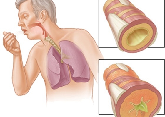 Sự xơ hóa thành phế quản không thể hồi phục