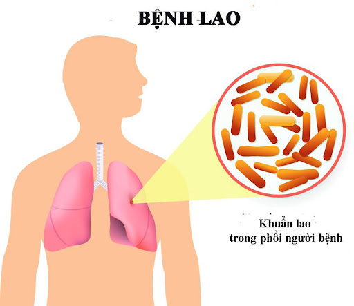 BoniDetox - Bí quyết từ Mỹ giúp phòng ngừa nguy cơ lao tái phát