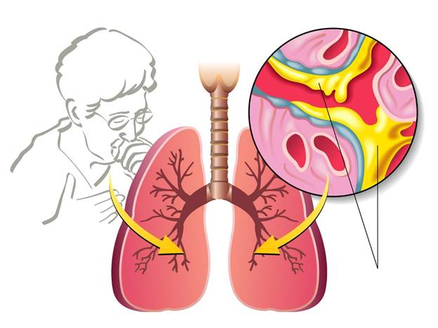 Ho, đờm, khó thở lâu ngày không khỏi - Giải pháp khắc phục an toàn và hiệu quả