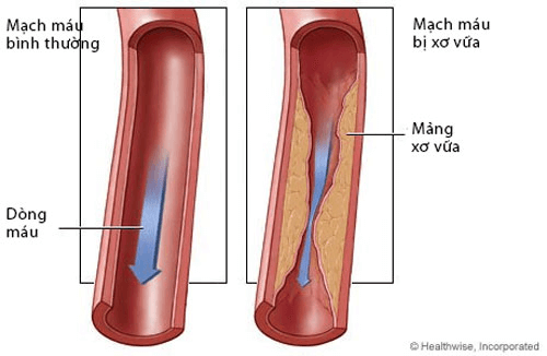 Xơ vữa gây hẹp động mạch ngoại vi