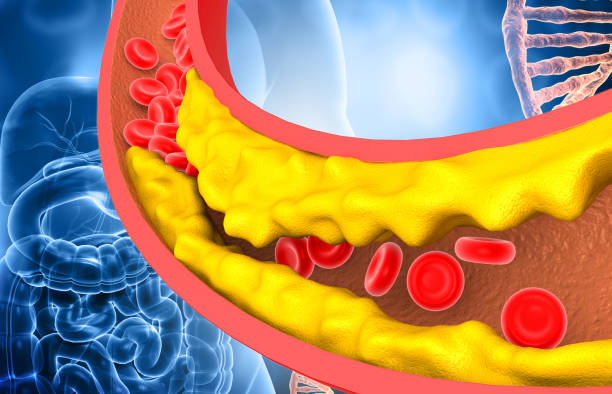 Cholesterol cao dễ gây mảng xơ vữa trong lòng mạch