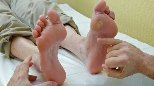 Khám bàn chân tiểu đường - Việc người bệnh cần làm ít nhất mỗi năm 1 lần