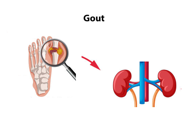 Bệnh gout gây nhiều biến chứng trên thận rất nguy hiểm