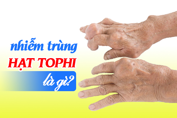 Nhiễm trùng hạt tophi là gì?