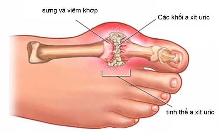 Acid uric tích tụ tạo các tinh thể muối urat gây hạt tophi