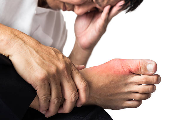 Bệnh gout gây những cơn đau gout cấp dữ dội