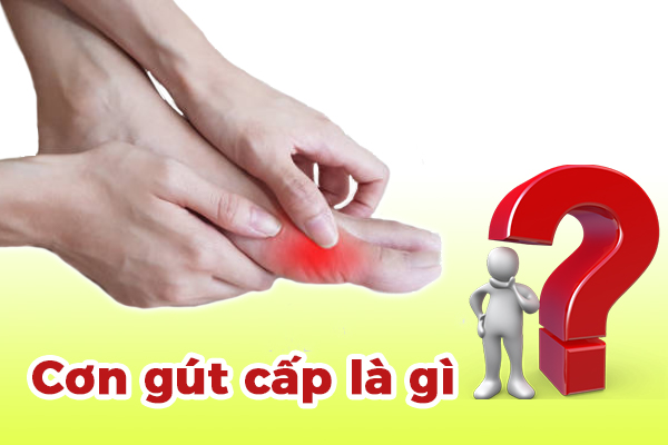 Cơn gút cấp là gì?