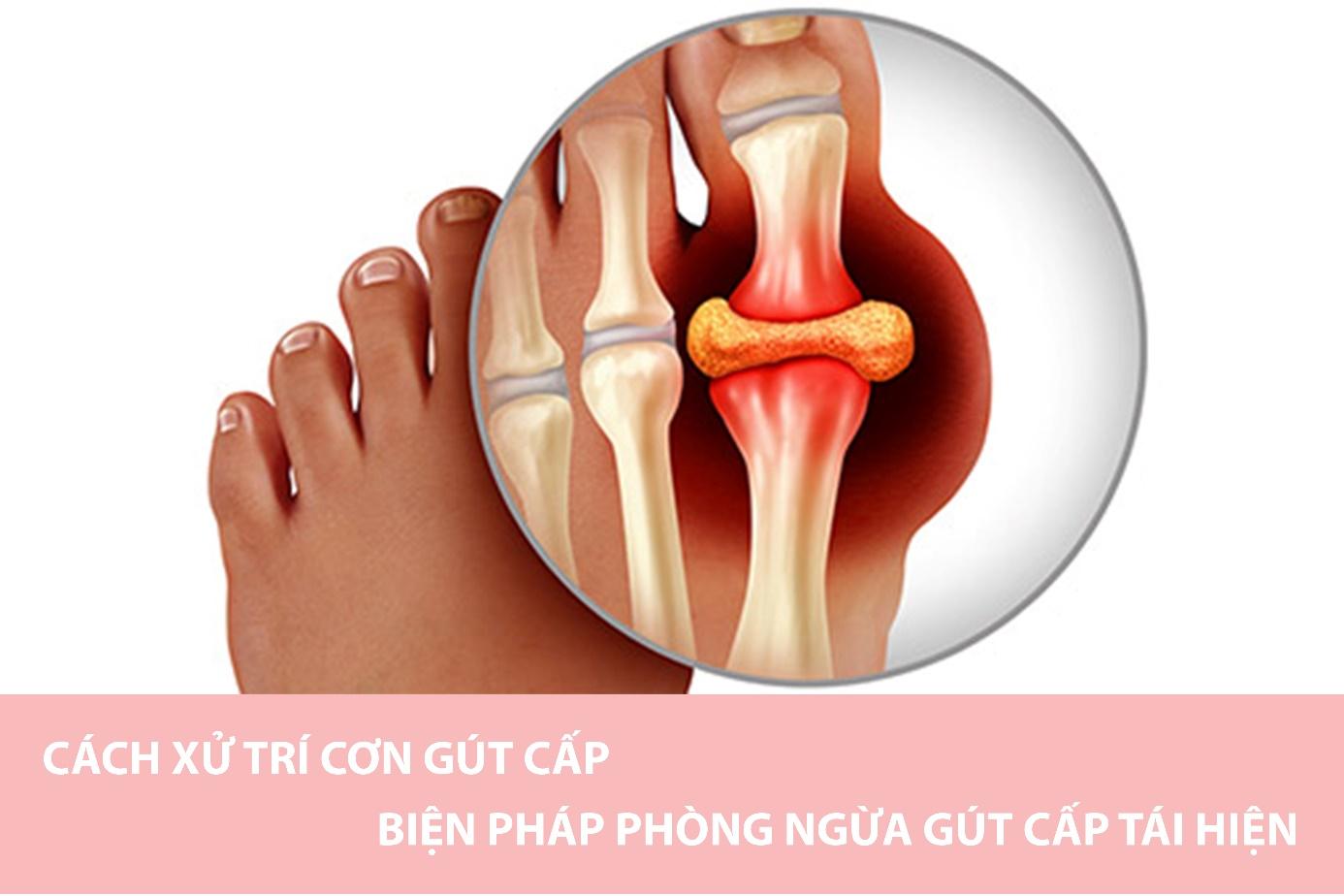 Cách xử trí cơn gút cấp và biện pháp phòng ngừa cơn gút cấp tái phát