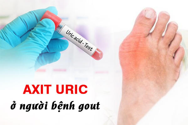 Cách hạ axit uric máu cho người bệnh gout