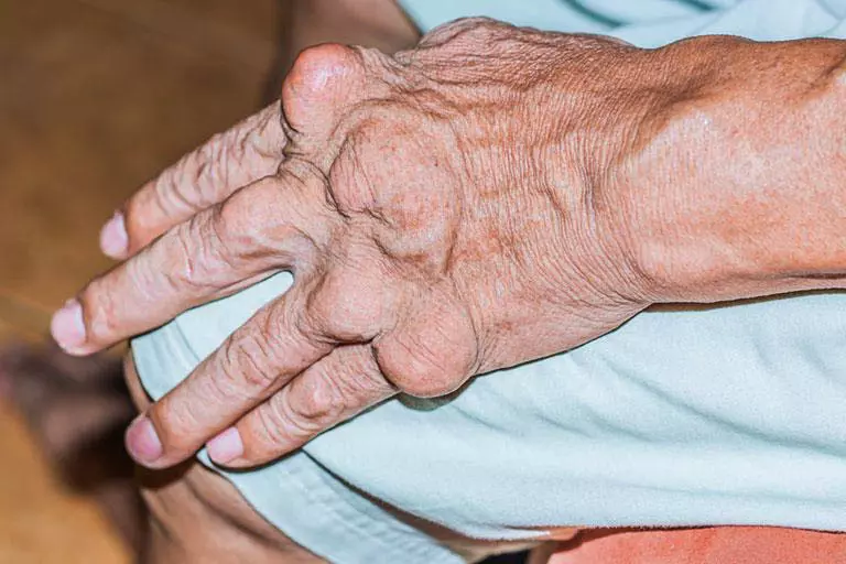 Những cách giúp làm xẹp hạt tophi cho người bệnh gút