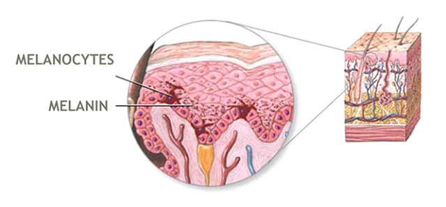 Bạc tóc do thiếu hụt sắc tố melanin