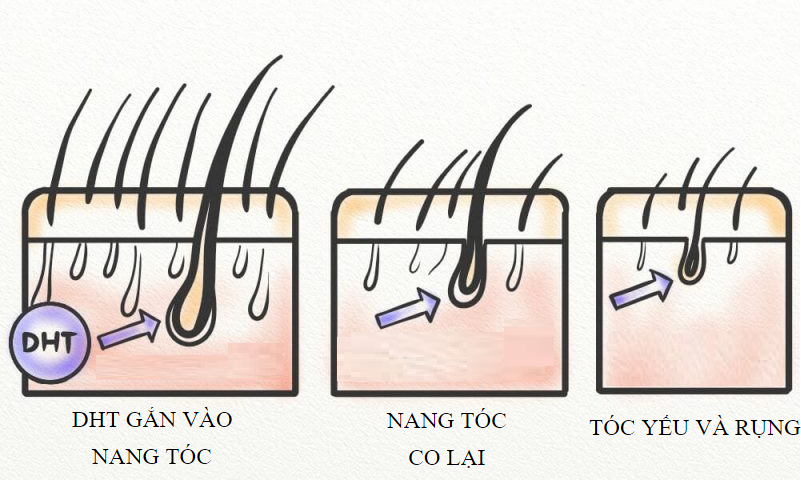 Hormone Dihydrotestosterone là thủ phạm hàng đầu gây tóc yếu rụng nhiều