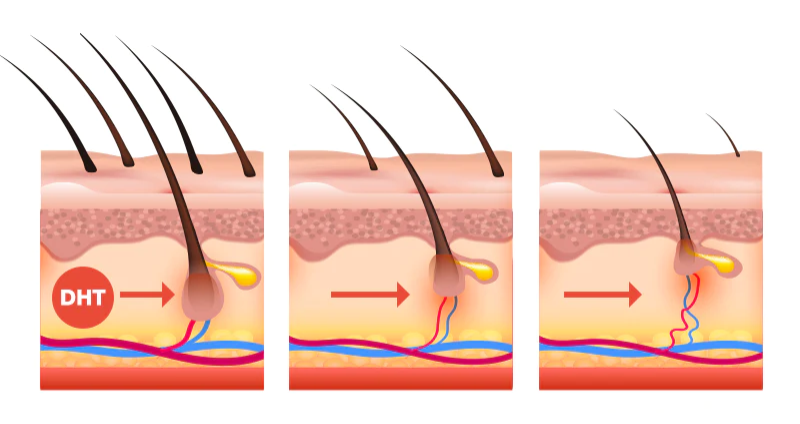DHT khiến chân tóc yếu đi, tóc dễ rụng và khó mọc lại