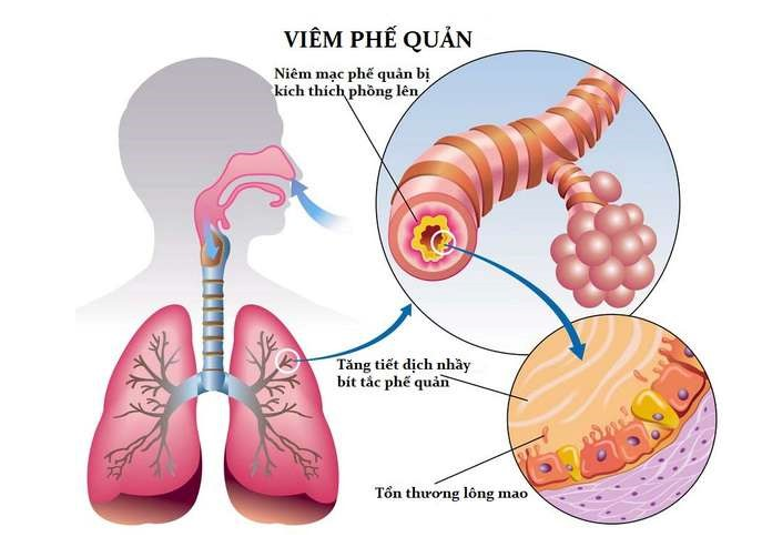 Viêm phế quản là gì?