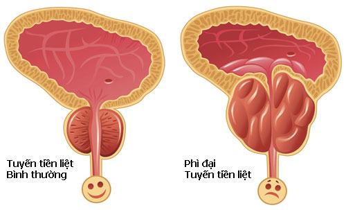 Nguyên nhân phì đại tiền liệt tuyến mà nam giới cần tránh xa, triệu chứng, hậu quả và giải pháp tốt nhất