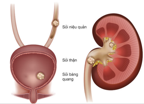 Phì đại tiền liệt tuyến có thể gặp những biến chứng gì?