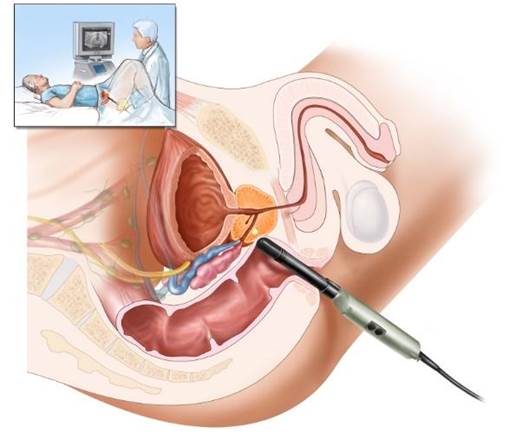 Siêu âm tiền liệt tuyến qua trực tràng