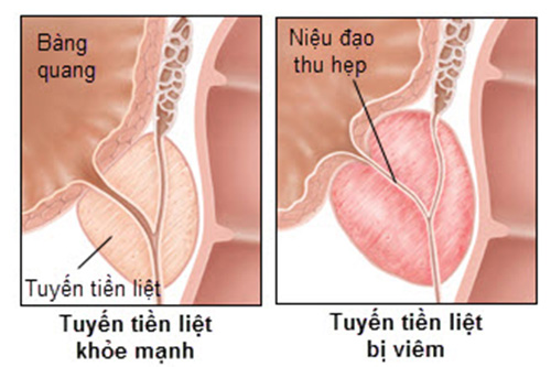 Biến chứng nhiễm khuẩn tiết niệu, viêm tuyến tiền liệt