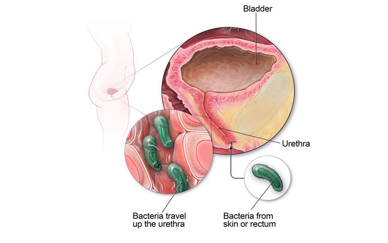 Nhiễm trùng đường tiết niệu gây ra triệu chứng tiểu buốt