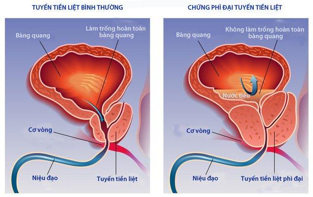 Phì đại tuyến tiền liệt gây tiểu buốt