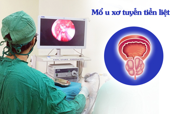 Biện pháp giúp ngăn ngừa bệnh tái phát sau mổ u xơ tuyến tiền liệt là gì?