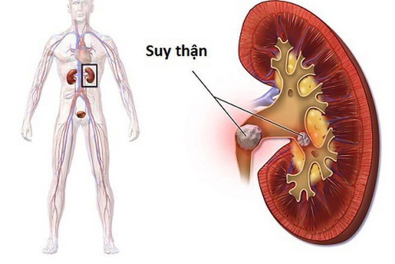 Suy thận - Biến chứng nguy hiểm của u xơ tuyến tiền liệt