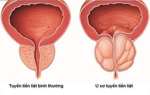 Tìm hiểu 3 giai đoạn phát triển của bệnh u xơ tuyến tiền liệt