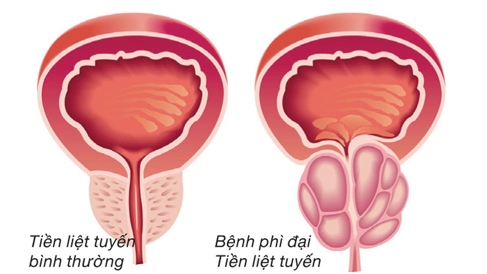 Phì đại tuyến tiền liệt có nguy hiểm không? Giải pháp khắc phục hiệu quả là gì?