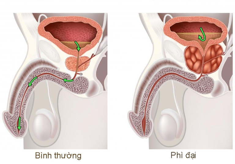 Phì đại tuyến tiền liệt là bệnh lý như thế nào?