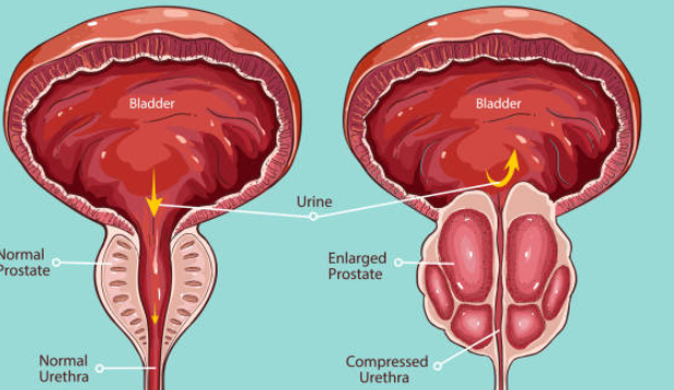 Phì đại tuyến tiền liệt là nguyên nhân hàng đầu gây ra tình trạng tiểu không tự chủ ở nam giới cao tuổi