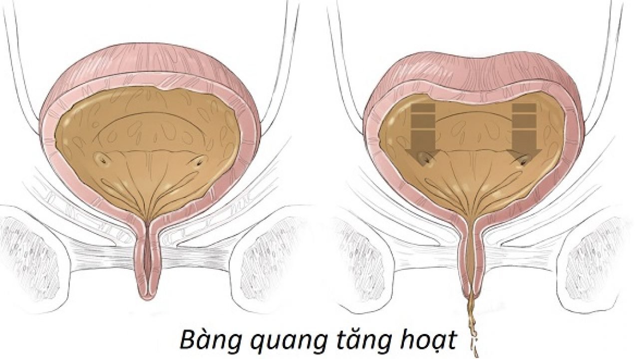 Bàng quang tăng hoạt khiến người bệnh buồn tiểu cả ngày lẫn đêm