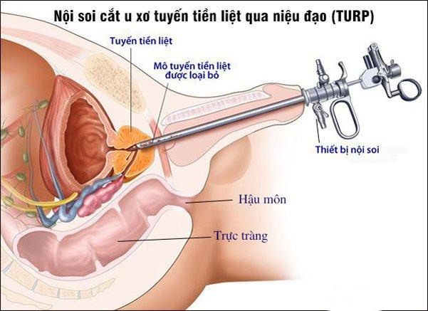 Phương pháp nội soi cắt tuyến tiền liệt qua niệu đạo.