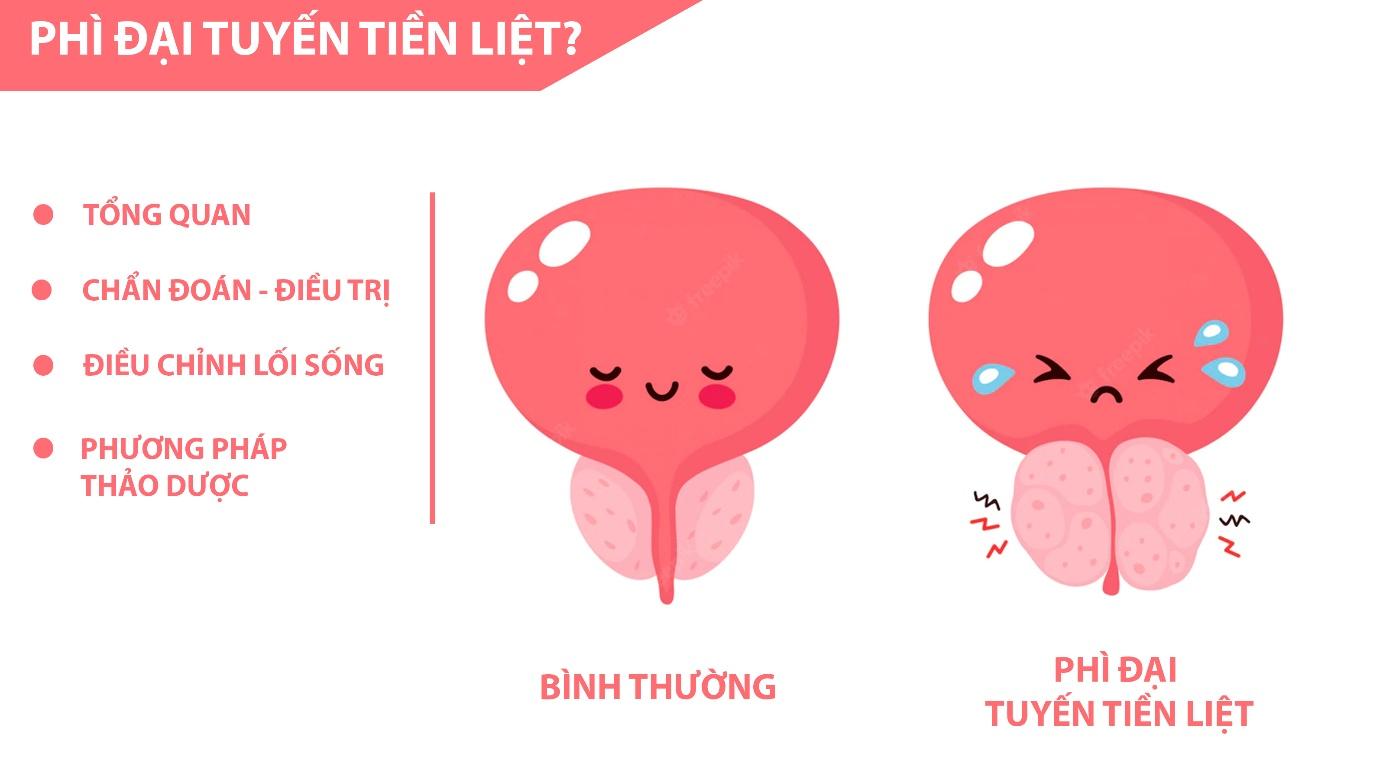 Phì đại tiền liệt tuyến - Lo đúng phương, chữa đúng hướng