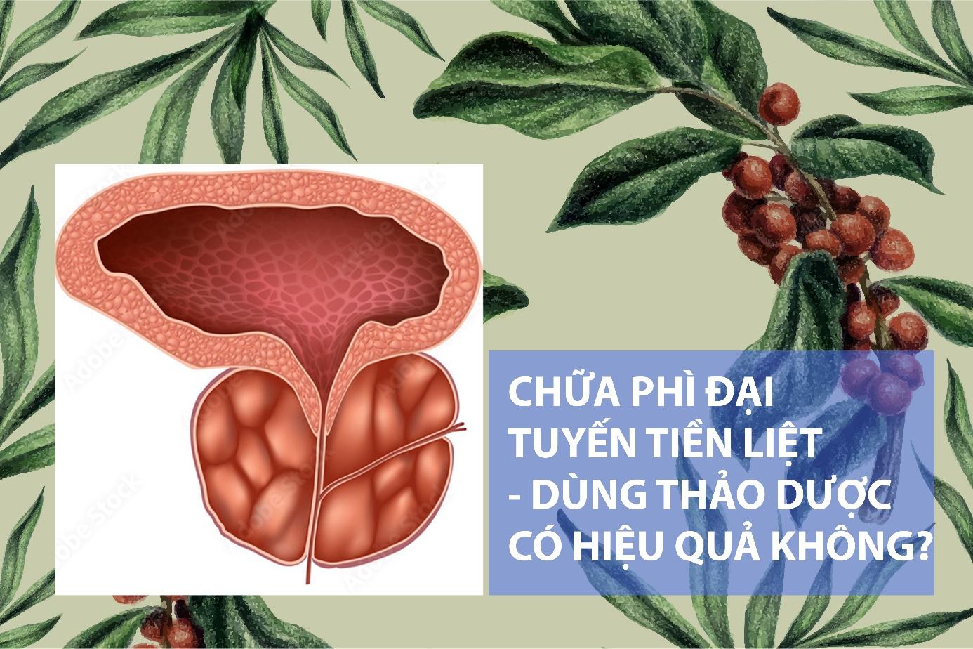 Phì đại tuyến tiền liệt: dùng thảo dược có hiệu quả không?