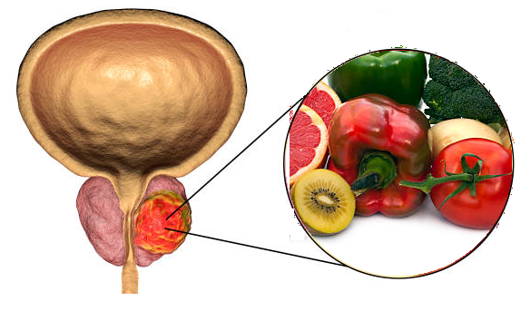 Chuyên gia giải đáp: Phì đại tuyến tiền liệt kiêng ăn uống gì?