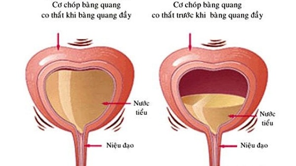 Nước tiểu tồn dư trong bàng quang sẽ gây đi tiểu nhiều lần