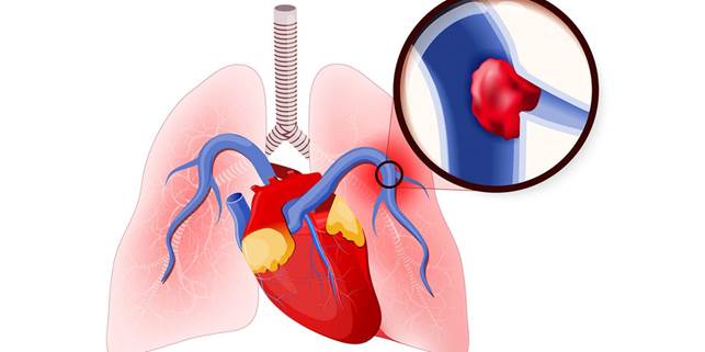 Đáng chú ý là tình trạng hình thành các cục huyết khối do máu ứ trệ nhiều, cục huyết khối có thể tách rời khỏi thành tĩnh mạch, đi về tim và gây thuyên tắc động mạch phổi, một biến chứng rất nặng đưa đến tử vong nếu không cấp cứu kịp thời.