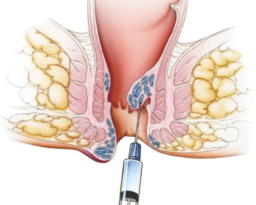 Gây xơ búi trĩ bằng cách tiêm trực tiếp