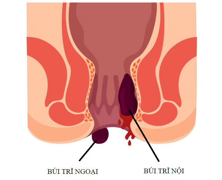 Bệnh trĩ là một trong những nguyên nhân phổ biến nhất gây ngứa hậu môn