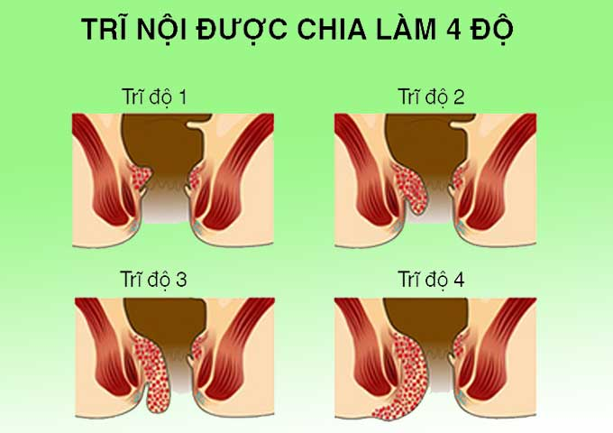 4 Cấp độ của bệnh trĩ nội