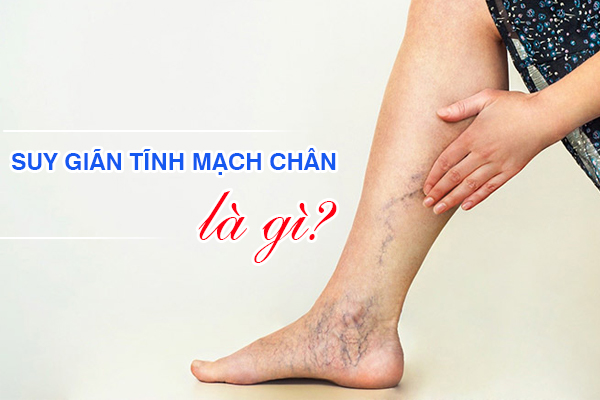 Suy giãn tĩnh mạch chân là gì?