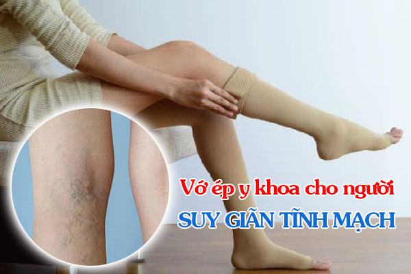 Những điều người bệnh suy giãn tĩnh mạch cần biết về vớ ép y khoa