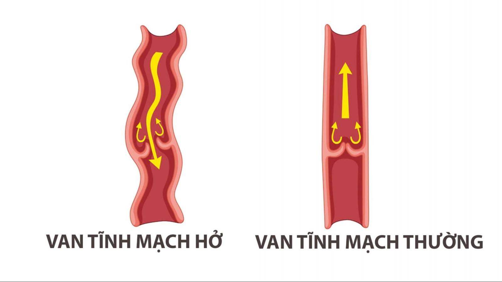 Van tĩnh mạch khi bị suy giãn