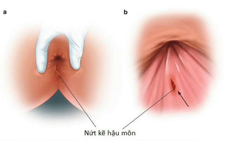 Nứt kẽ hậu môn gây đau rát, chảy máu