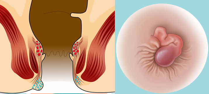 Búi trĩ mọc thường không đều nhau